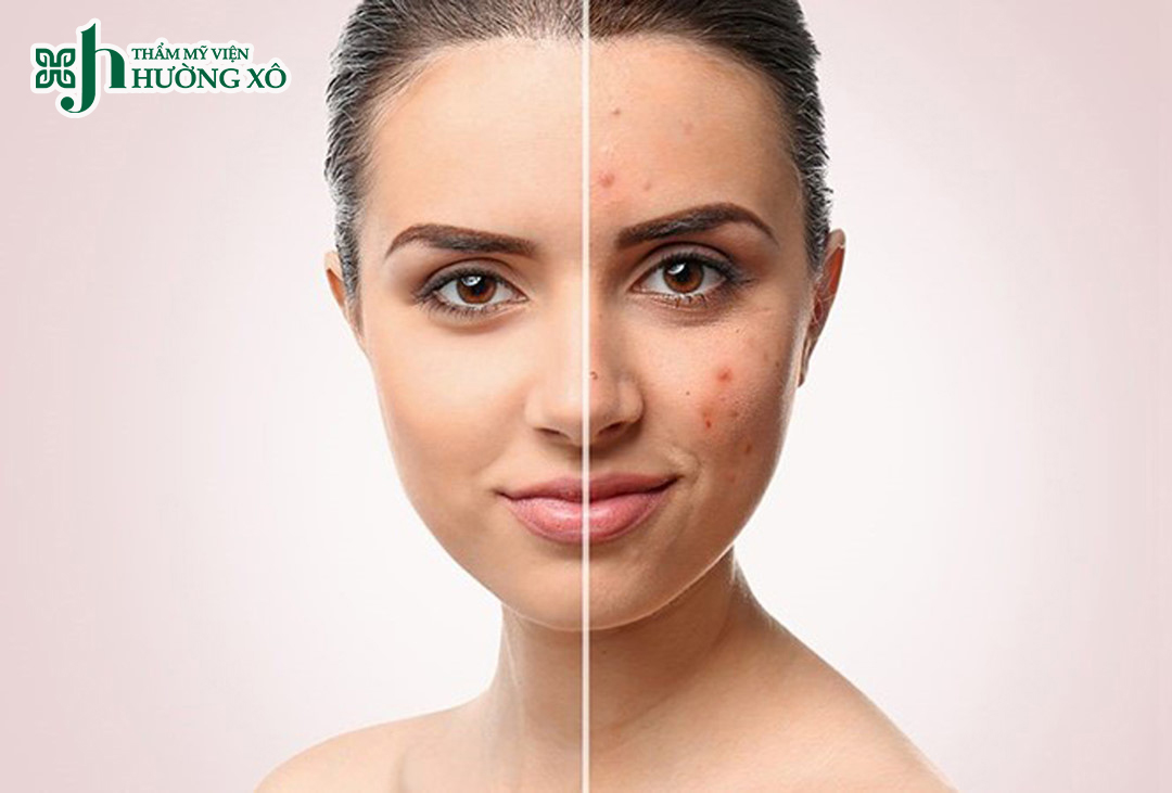 Điều trị thâm mụn