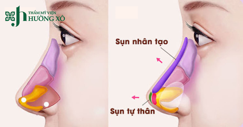 Nâng mũi cấu trúc