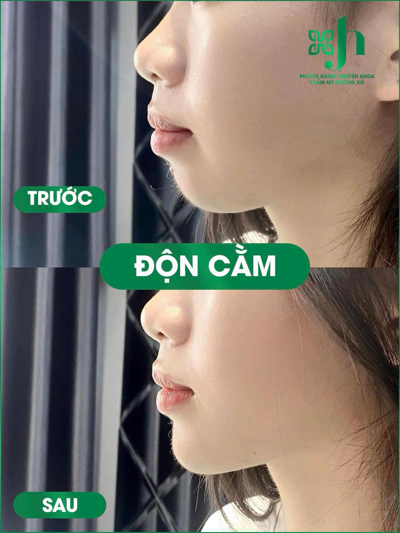 Độn cằm