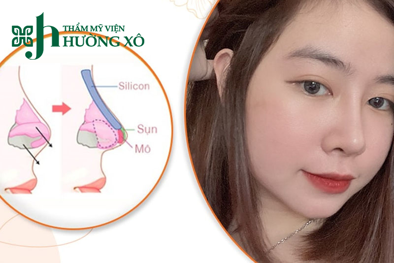 Nâng mũi bọc sụn