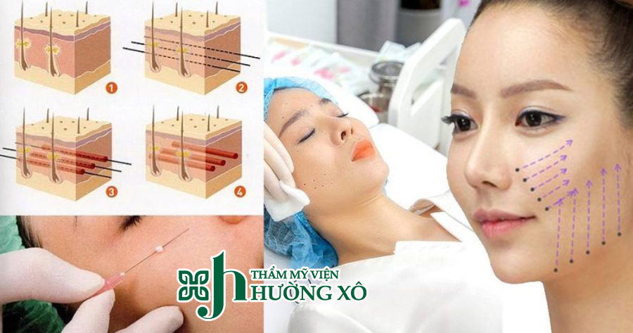 căng chỉ collagen