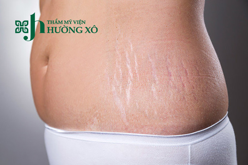 Điều trị rạn da sau sinh