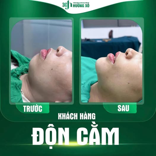 Độn cằm