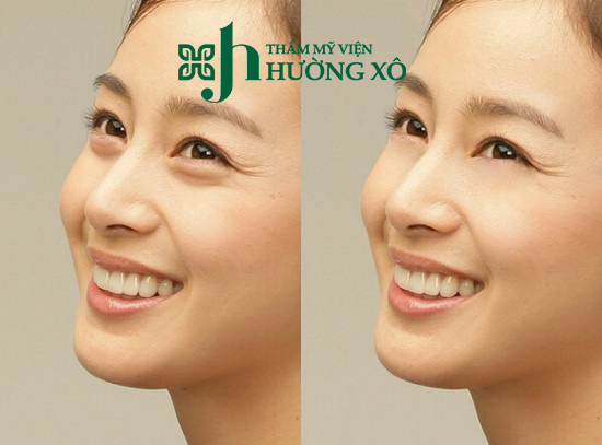 lấy mỡ bọng mắt