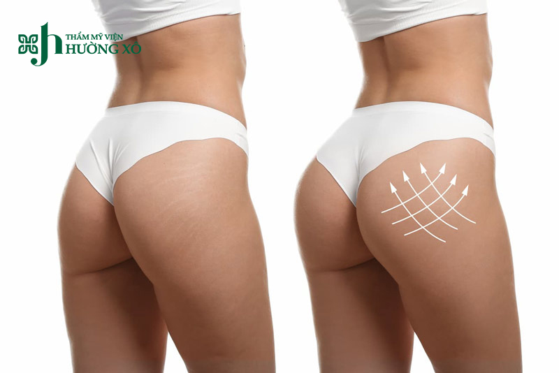 Dịch vụ độn mông