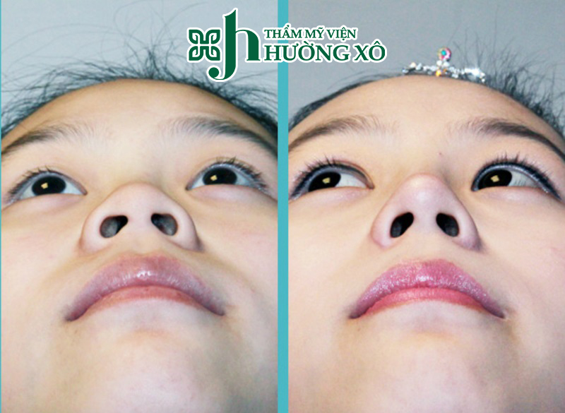 Thu gọn cánh mũi