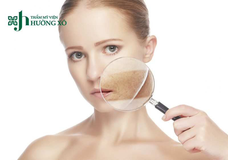 Điều trị nám da