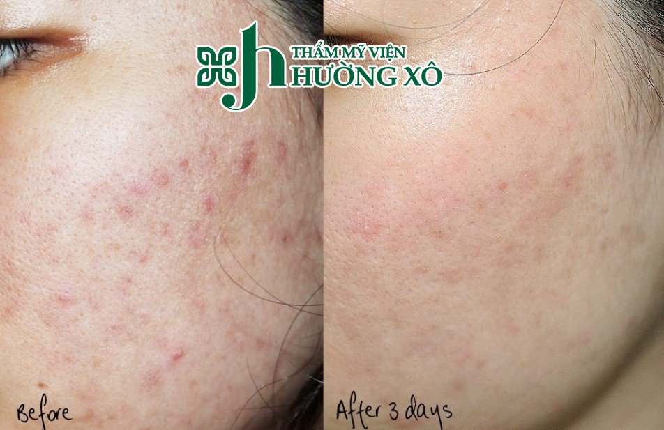 Điều trị thâm mụn