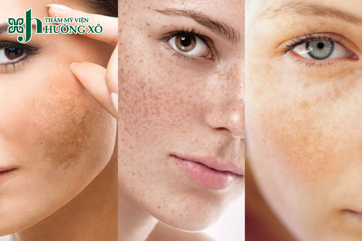 Điều trị nám da