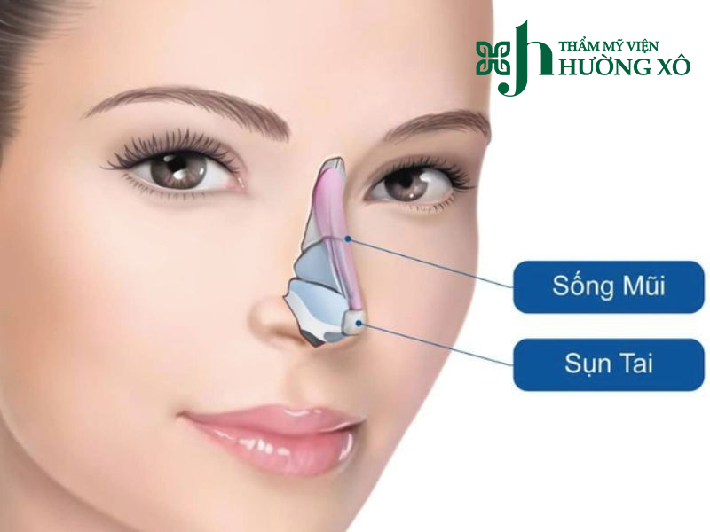 Nâng mũi cấu trúc