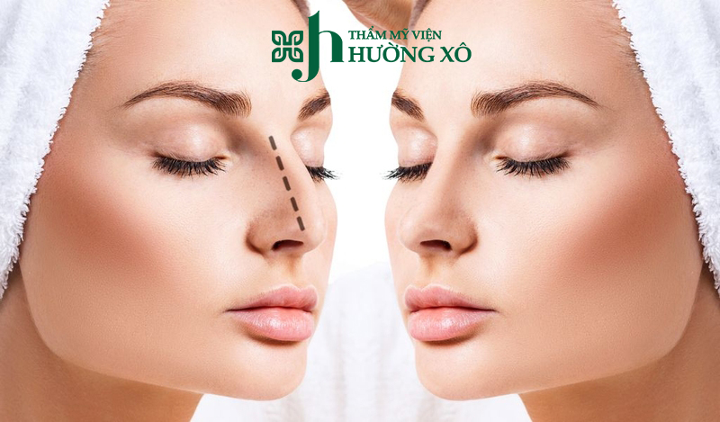 Nâng mũi bán cấu trúc