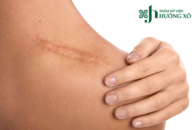 Tiêm tan sẹo lồi