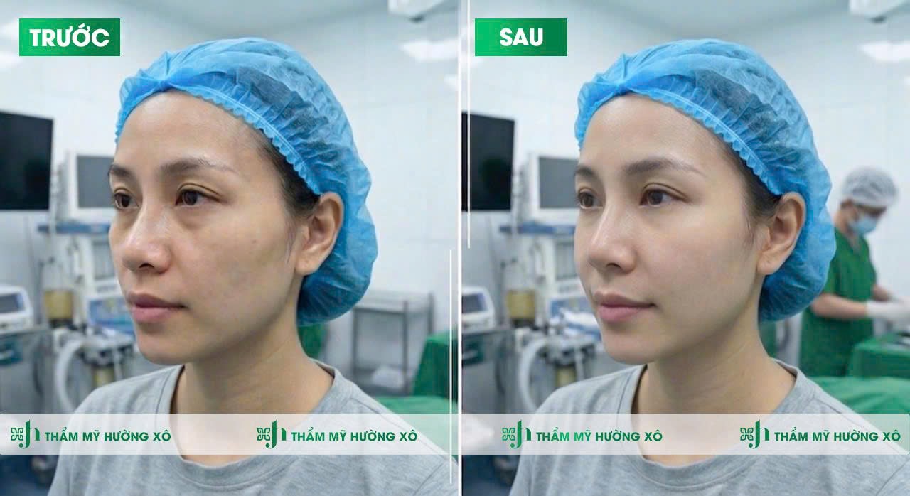 Độn thái dương