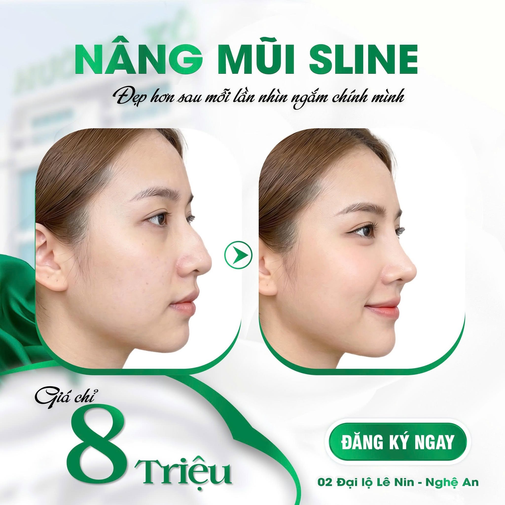 Nâng mũi S Line