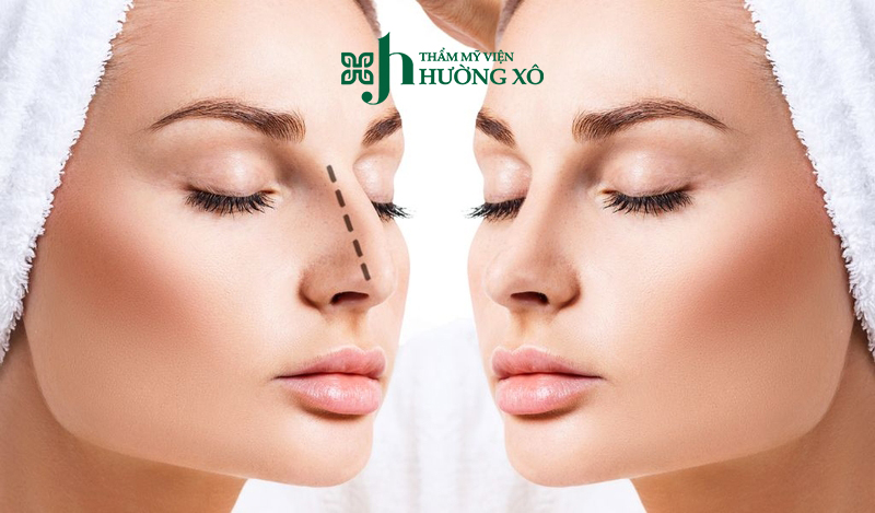 Nâng mũi bán cấu trúc