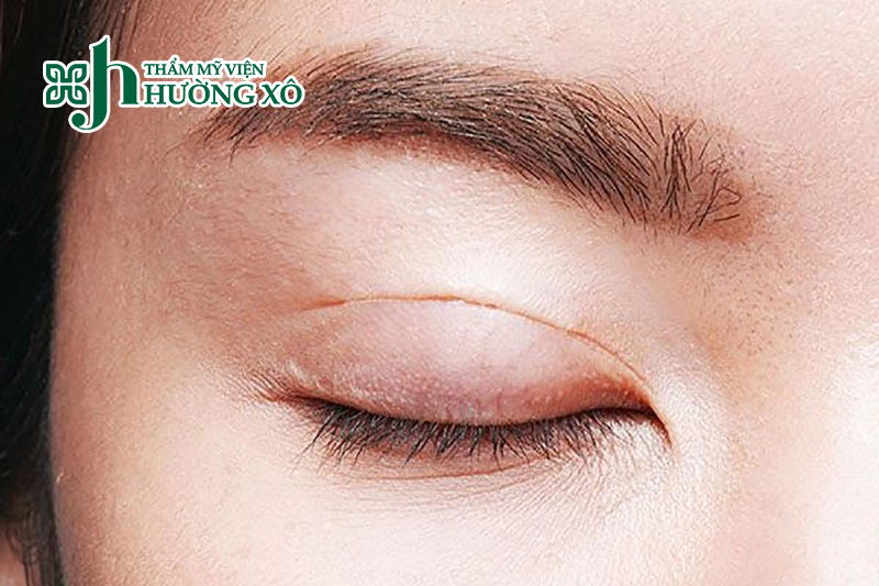 Cắt mí nội soi