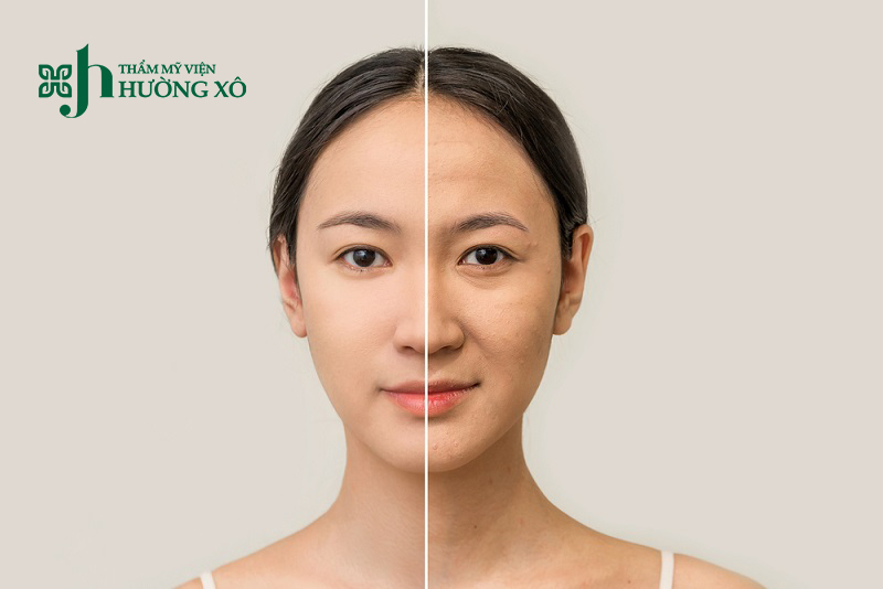 Nâng cơ mặt