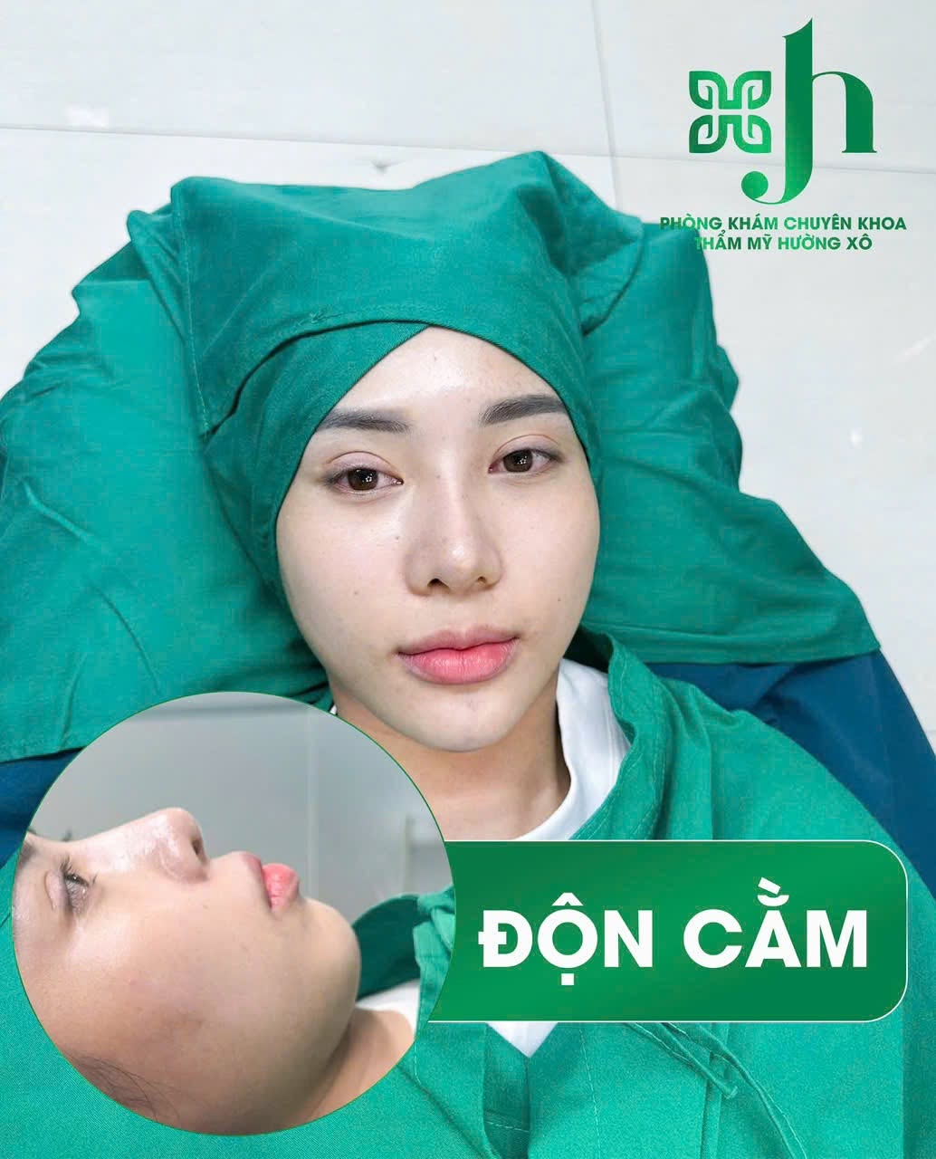 Độn cằm V-Line