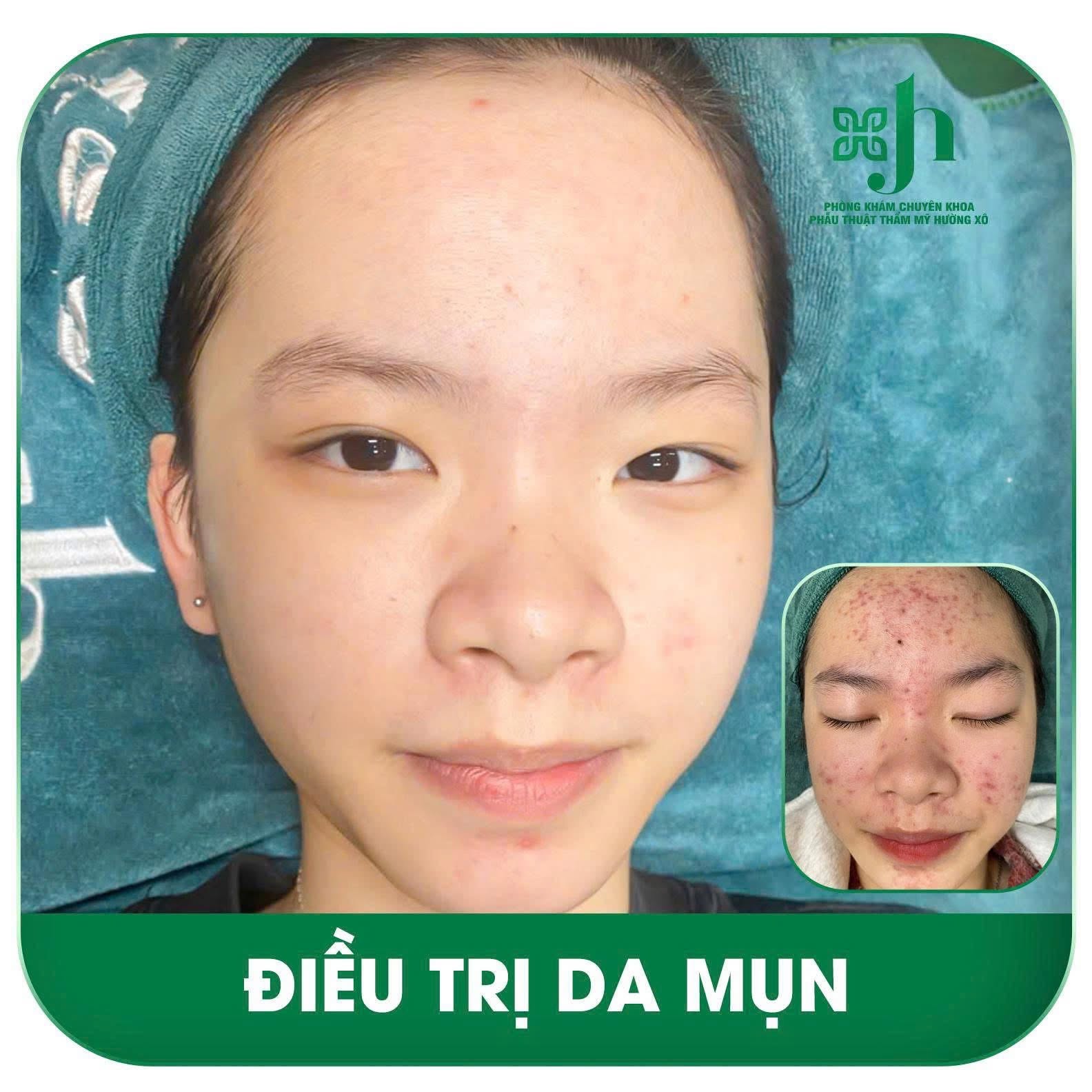 Điều trị da mụn