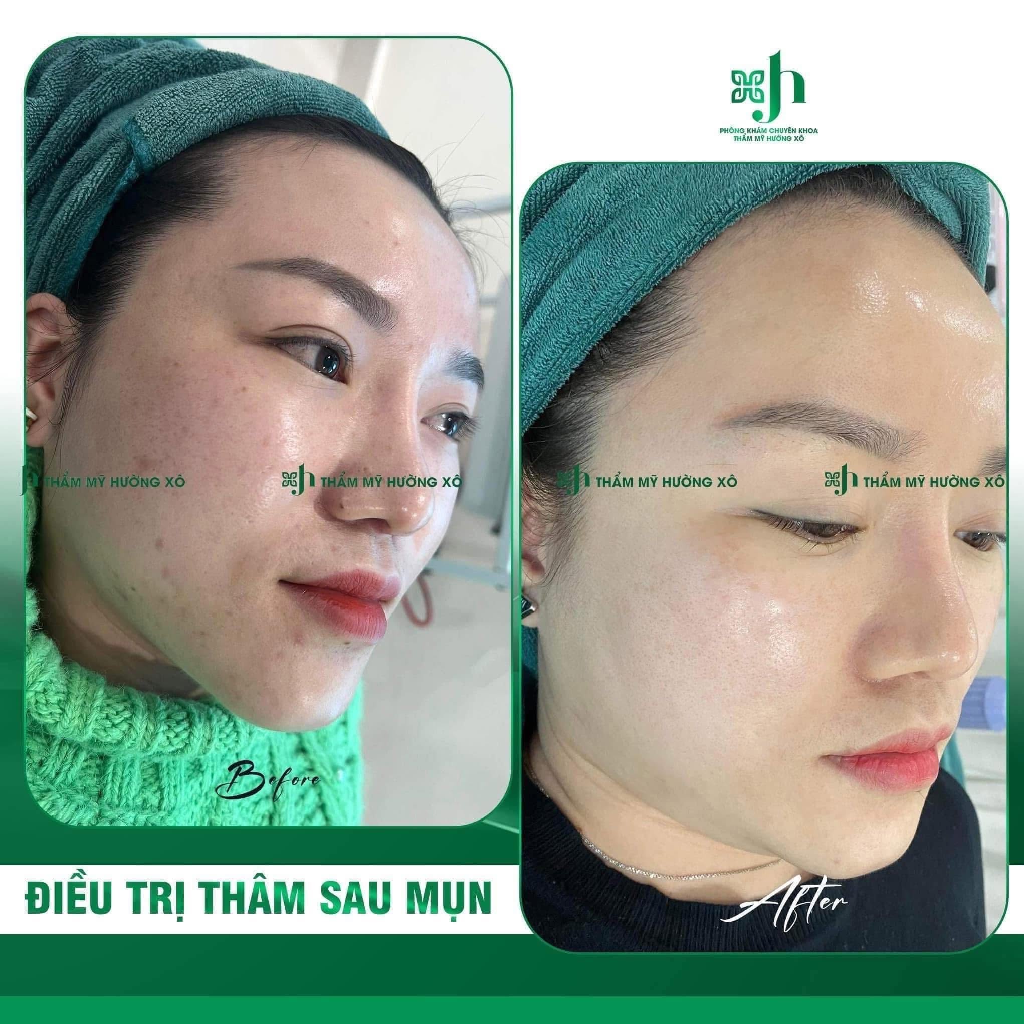Điều trị da mụn
