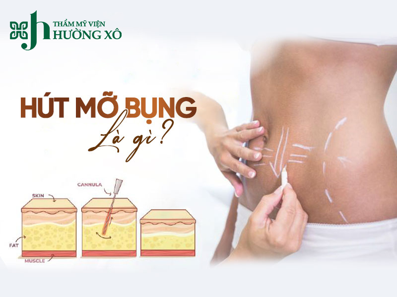Hút mỡ bụng