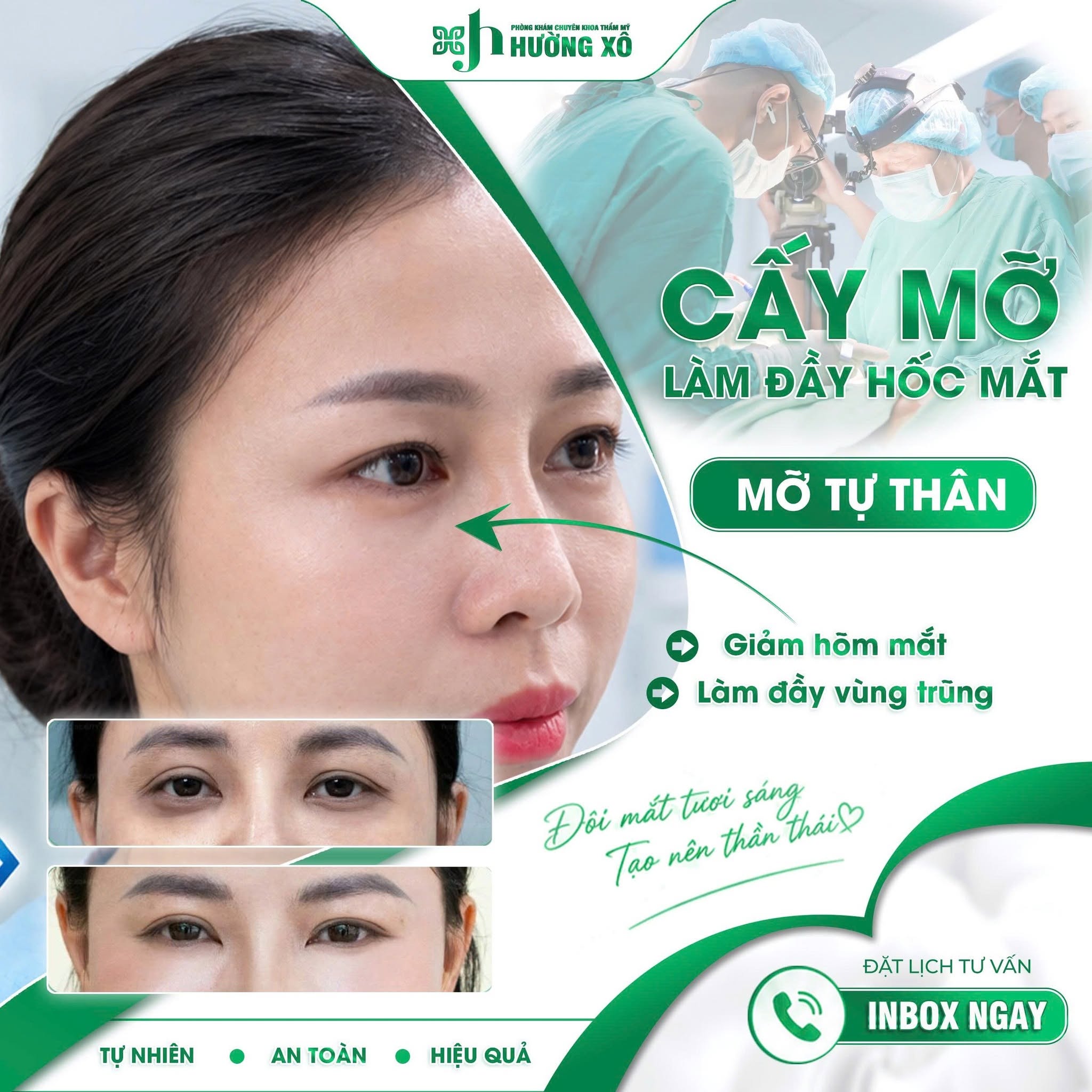 cấy mỡ hốc mắt