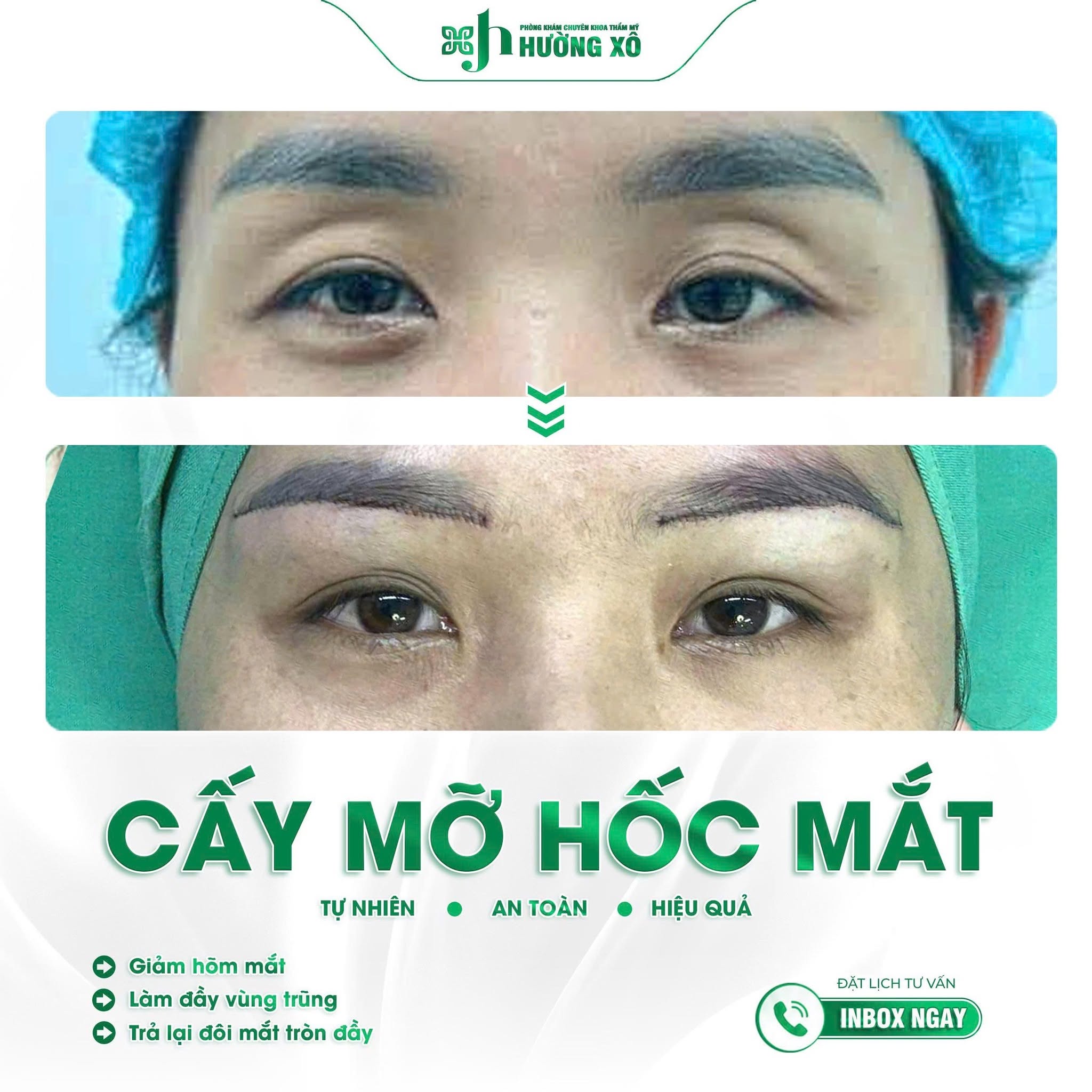 cấy mỡ hốc mắt
