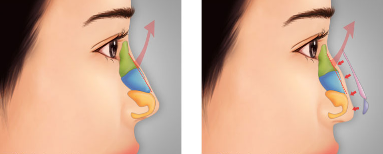 Ưu điểm của kỹ thuật phẫu thuật sửa lại mũi đã hỏng