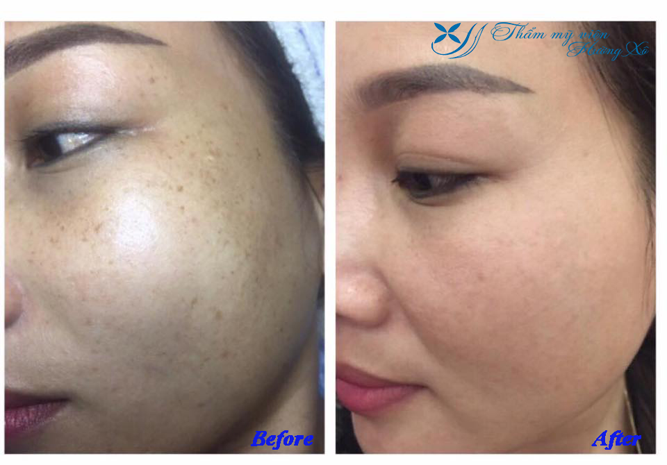 Điều trị nám tàn nhang tại Vinh, Nghệ An