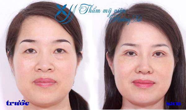 Lấy mỡ bọng mắt an toàn tại Vinh Nghệ An