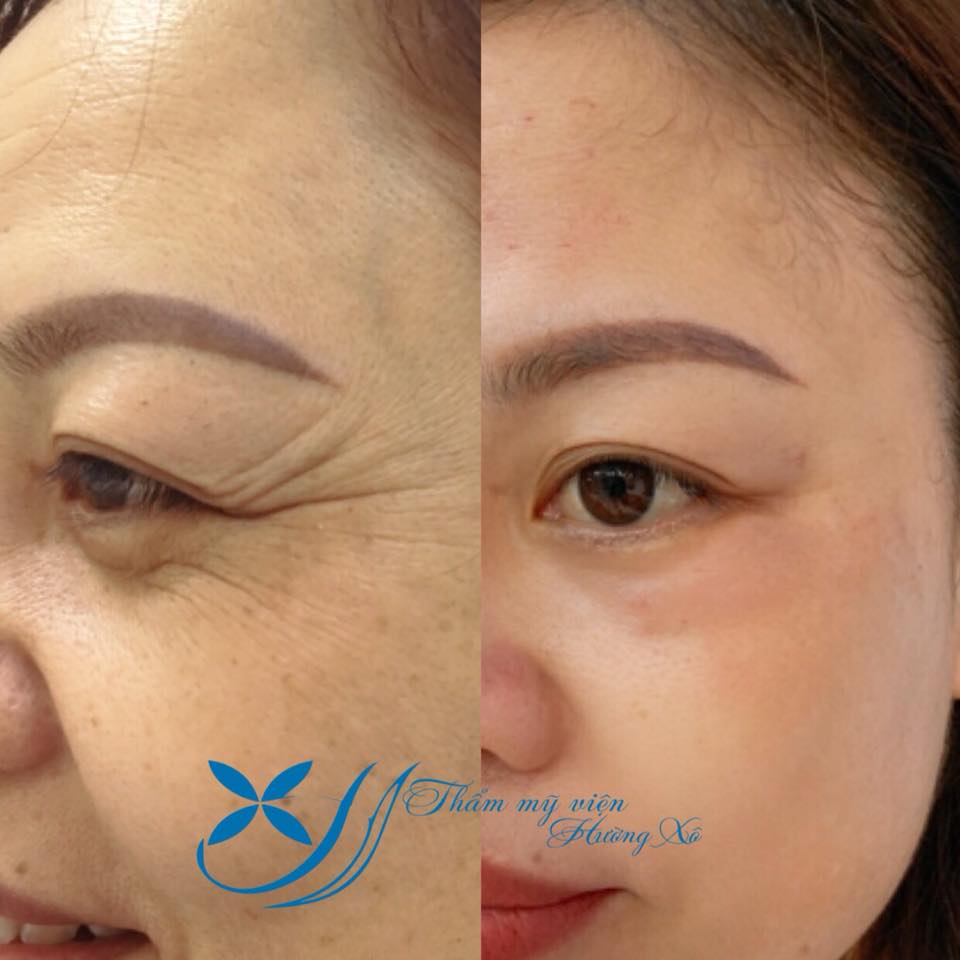 Căng da mặt bằng chỉ Ultra V Lift tại Vinh, Nghệ An