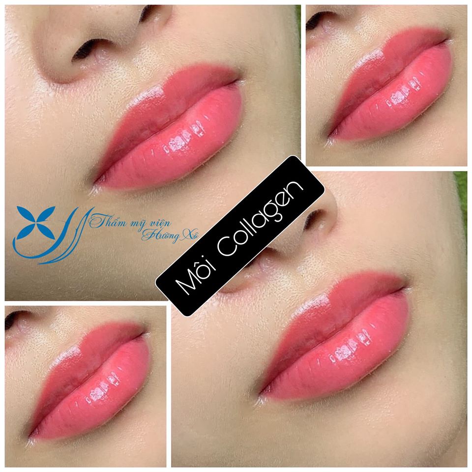 Địa chỉ phun môi collagen uy tín tại vinh, Nghệ An