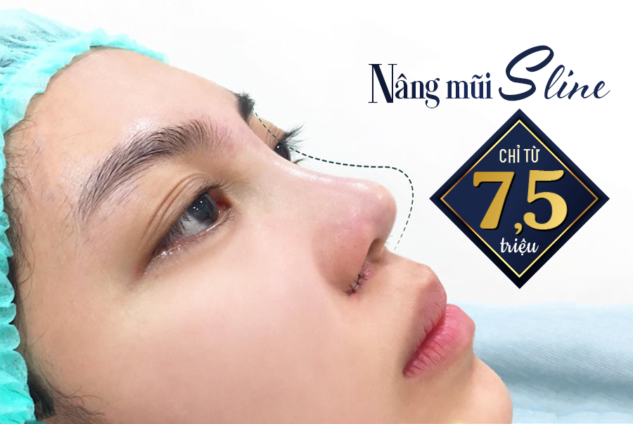 THẨM MỸ HƯỜNG XÔ ƯU ĐÃI 20 SUẤT NÂNG MŨI SLINE GIẢM TỚI 50%