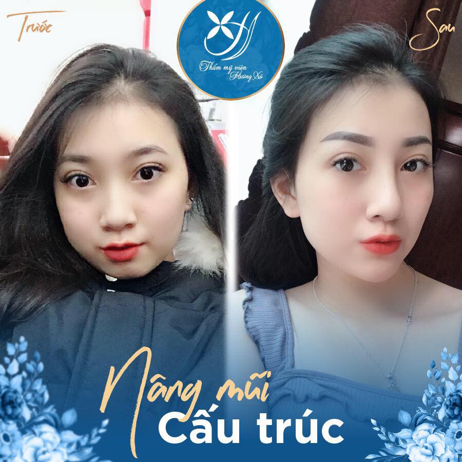 Địa Chỉ Nâng Mũi Cấu Trúc An Toàn Hiệu Quả tại Vinh Nghệ An