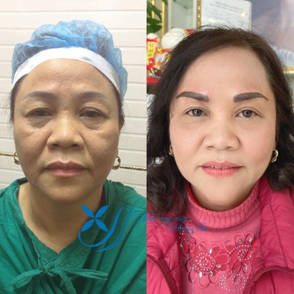 Trẻ Hóa Da Mặt Công Nghệ Cao tại Hà Tĩnh