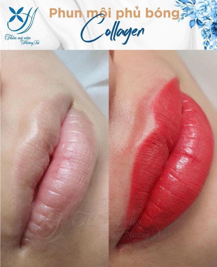Địa chỉ phun môi Collagen chất lượng tại Vinh