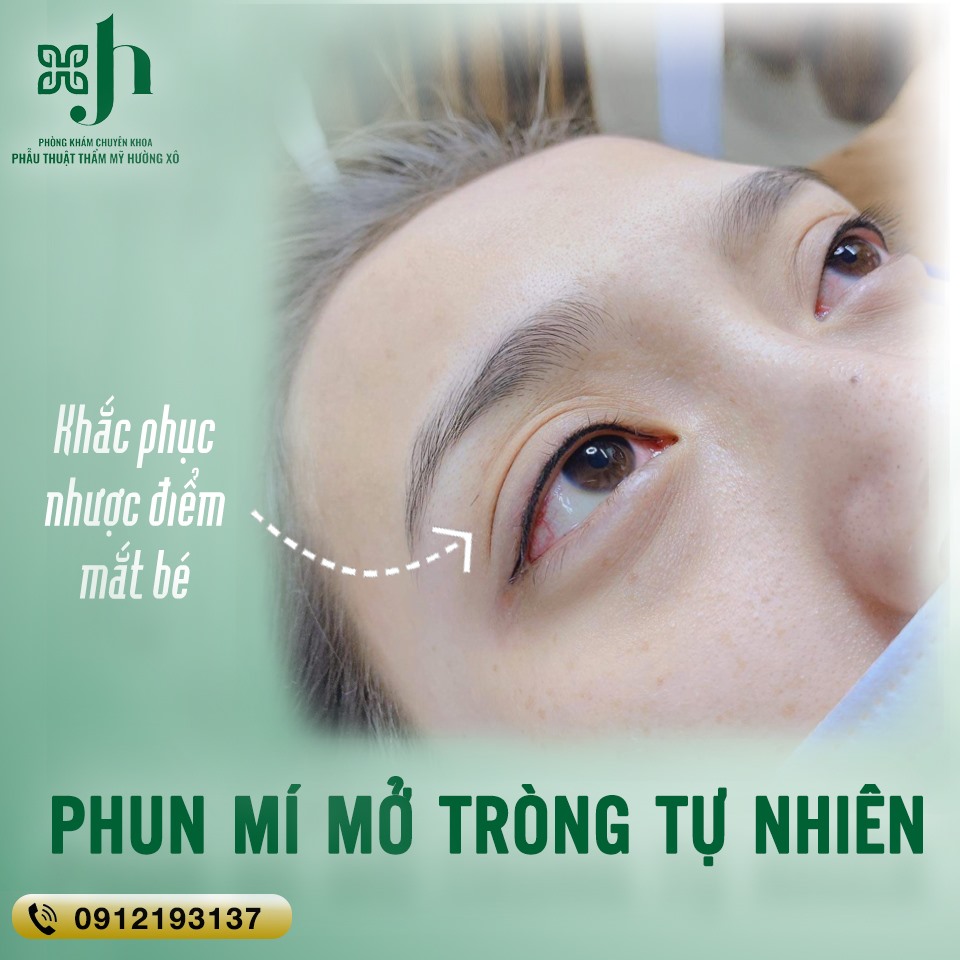 Phun Mí Mở Tròng Tự Nhiên tại Vinh, Nghệ An