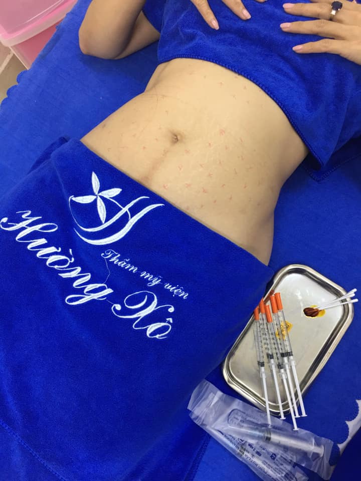 Giảm béo Smart Lipo An Toàn Chất Lượng tại Vinh