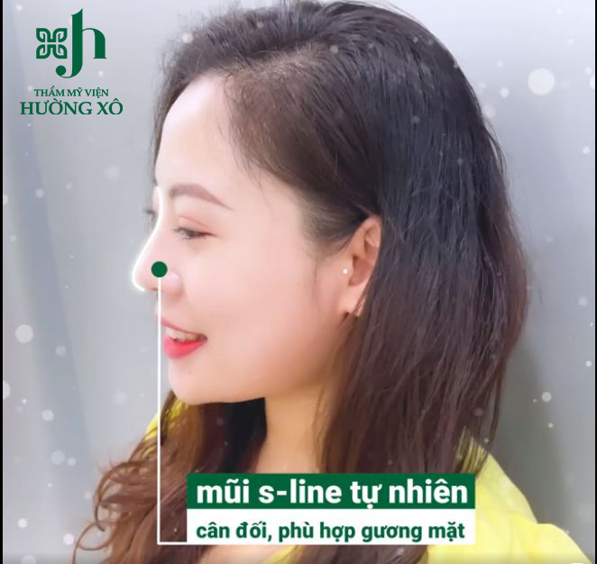 Địa Chỉ Nâng Mũi S-line Uy Tín, Tin Cậy tại Vinh, Nghệ An