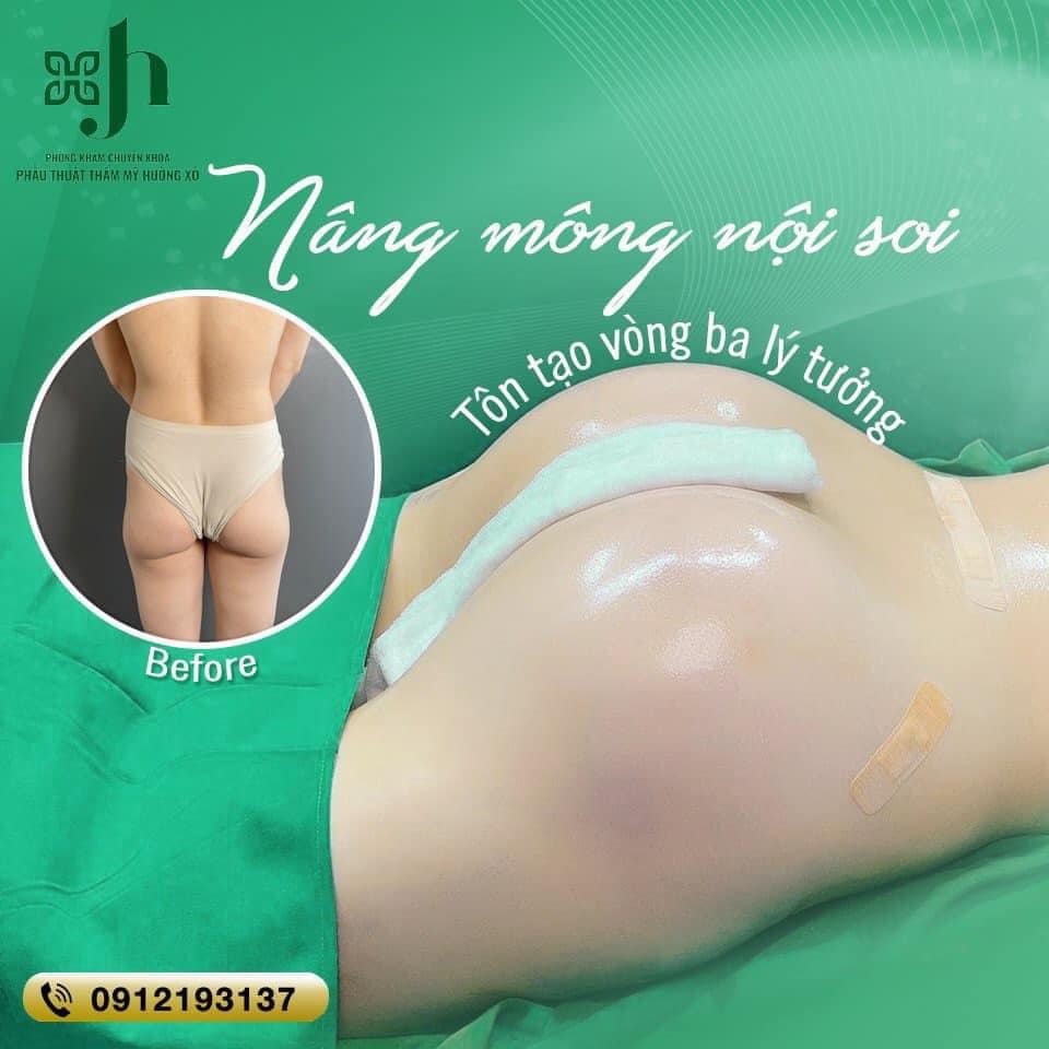 Nâng Mông Nội Soi tại Vinh, Nghệ An - Mông To Đẹp - An Toàn - Bền Lâu