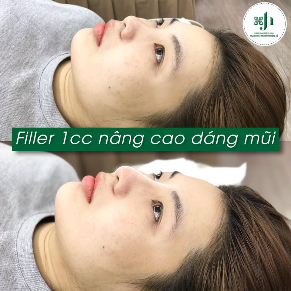 Tiêm Filler - Tái Cấu Trúc Toàn Diện Dáng Mũi Bằng Filler An Toàn Hiệu Quả tại Vinh, Nghệ An