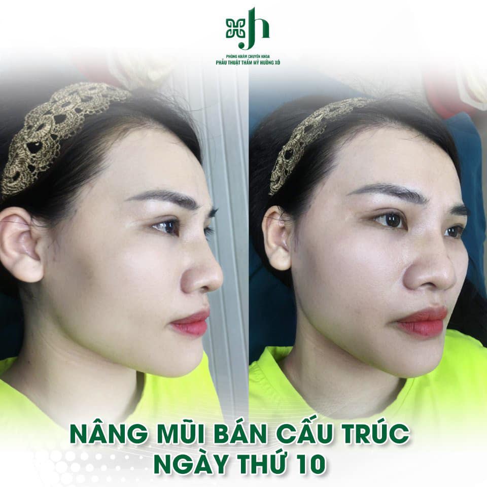 Nâng Mũi Bán Cấu Trúc Đẹp, An Toàn tại Vinh, Nghệ An