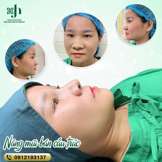 Chọn Nâng Mũi Cấu Trúc hay Bán Cấu Trúc - Địa Chỉ Nâng Mũi Uy Tín tại Vinh