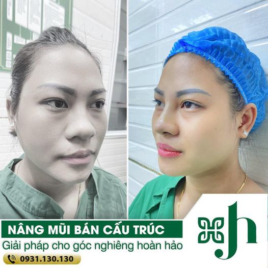 Nâng Mũi Bán Cấu Trúc tại Vinh - Giải Pháp Cho Góc Nghiêng Hoàn Hảo