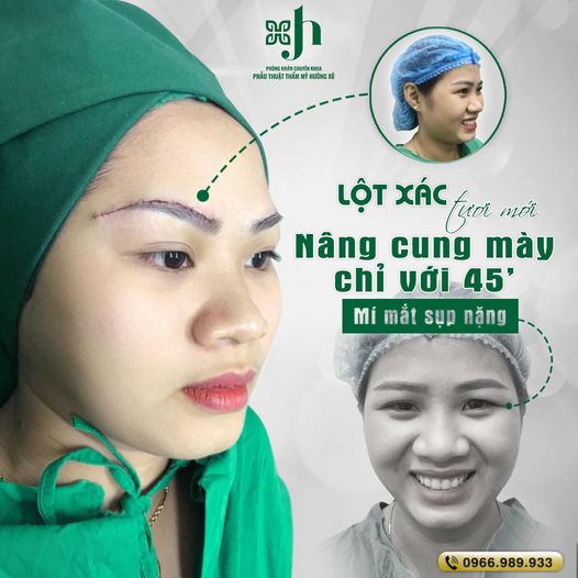 Nâng Cung Mày tại Vinh - Hết Sụp Mí, Trẻ Hóa Mắt Toàn Diện