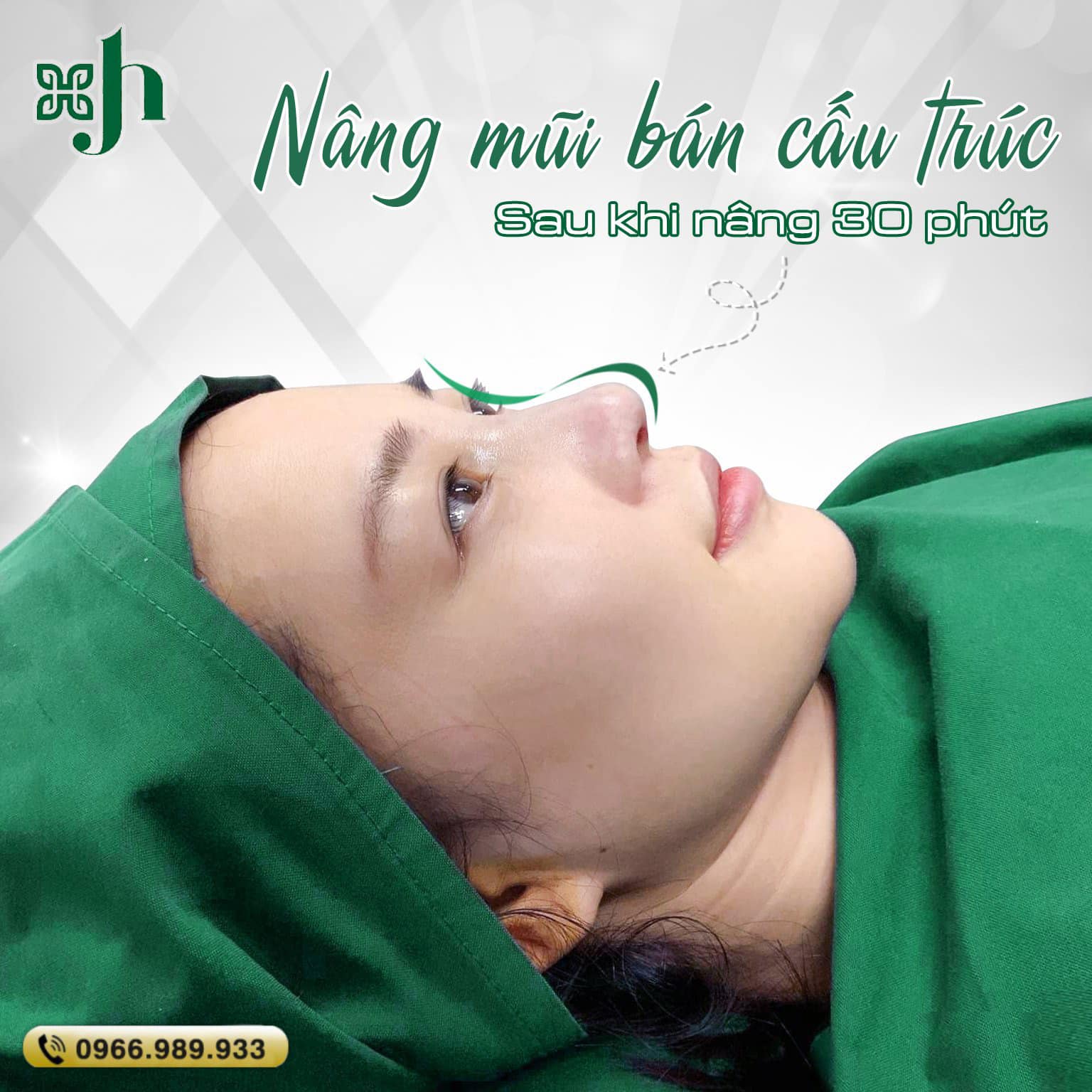 TMV Hường Xô - Nâng Mũi Bán Cấu Trúc, Đẹp Ngay Chỉ Sau 30 Phút