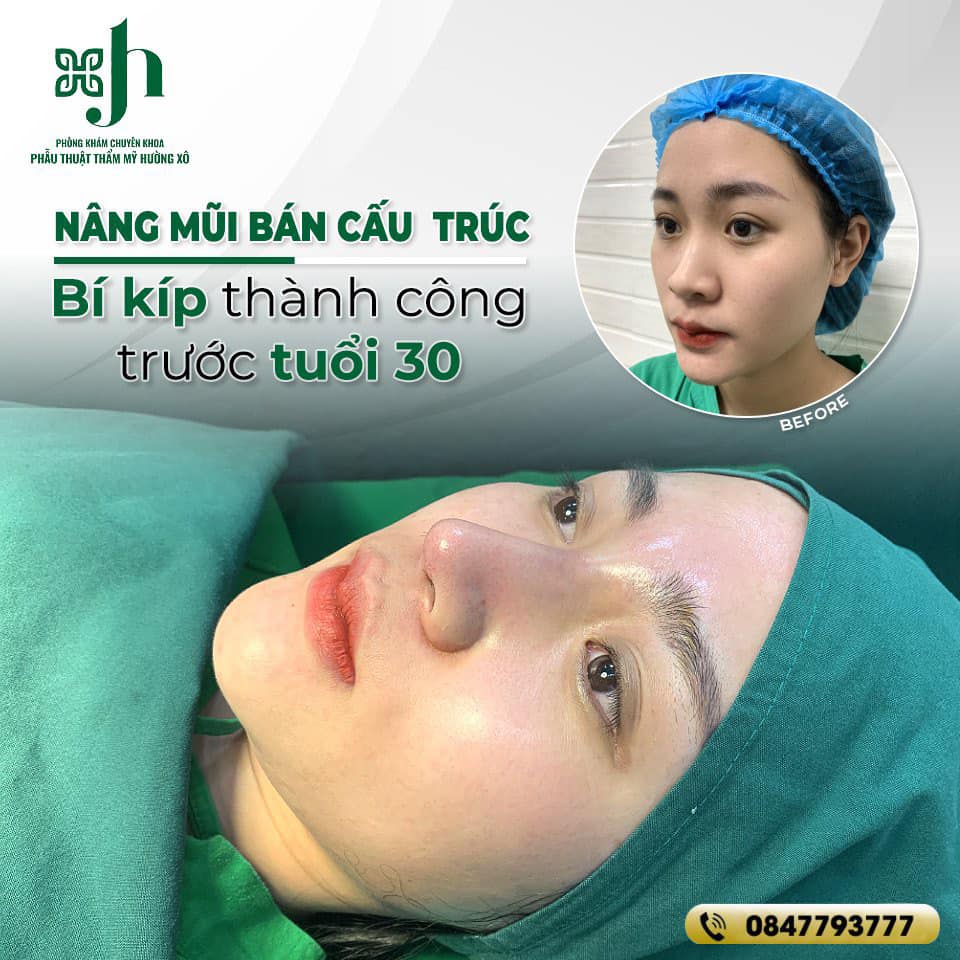 Nâng Mũi Bán Cấu Trúc - Bí Kíp Thành Công Trước Tuổi 30