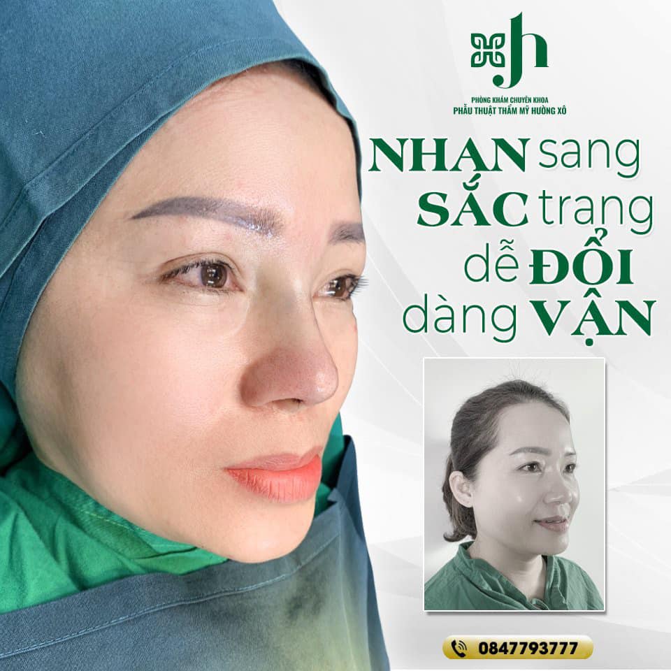 Nhan Sắc Sang Trang Dễ Dàng Đổi Vận với Nâng Mũi Bán Cấu Trúc tại Vinh