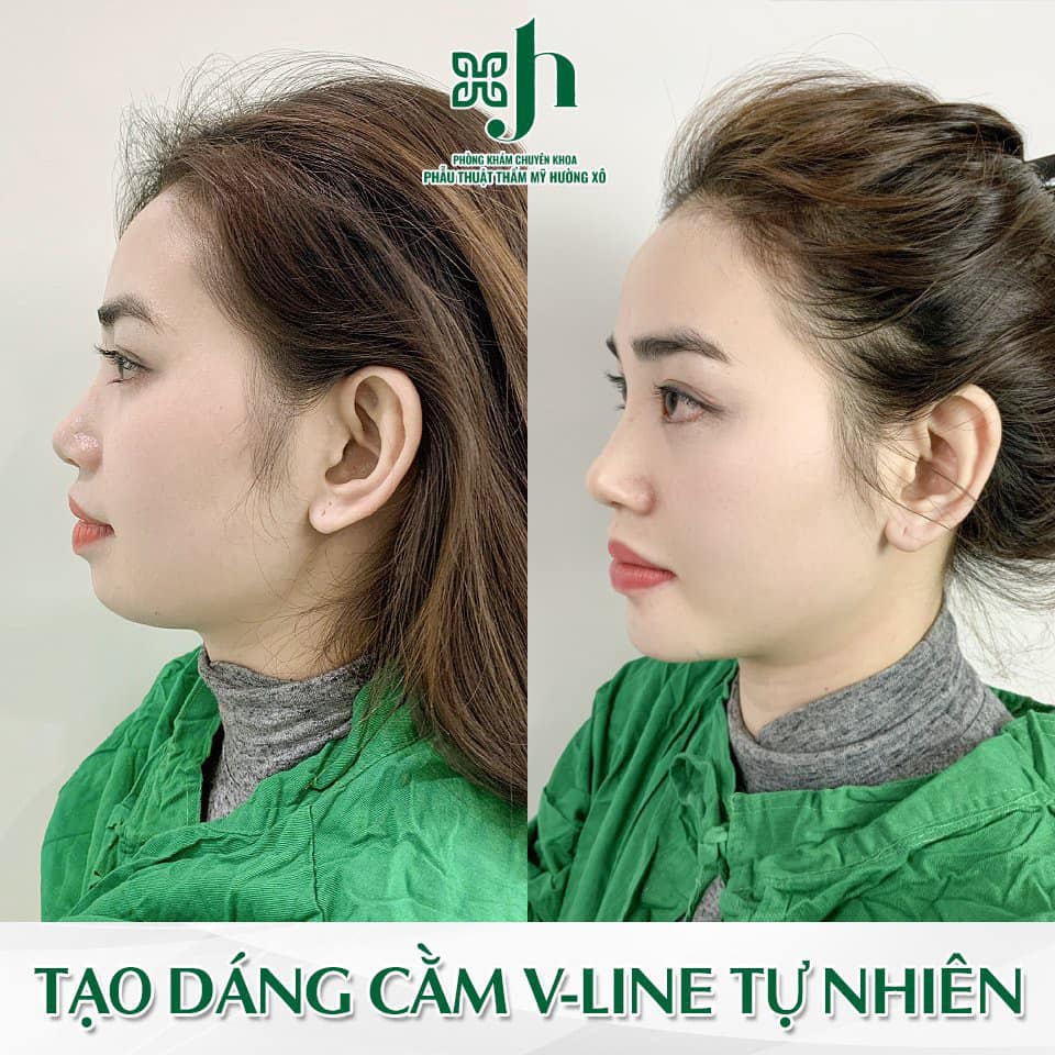 TMV Hường Xô: Độn Cằm V-Line tại Vinh - Cân Chỉnh Gương Mặt Tỷ Lệ Vàng
