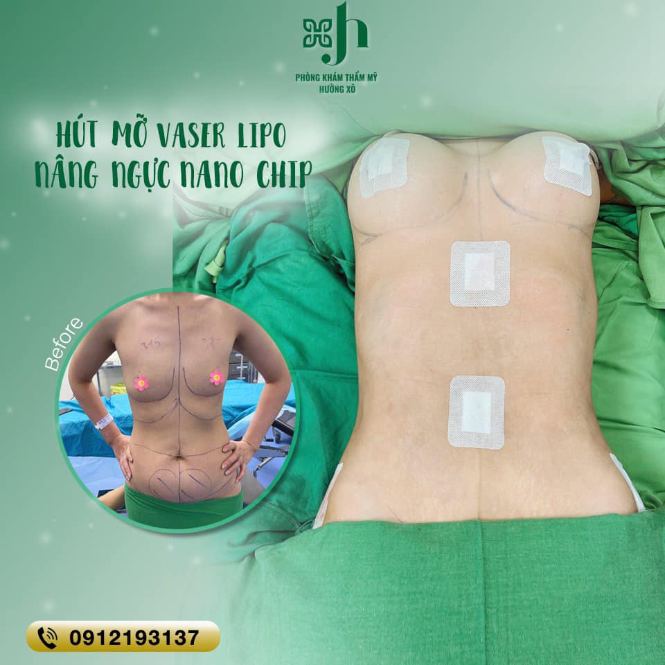 Hút Mỡ Vaser Lipo - Nâng Ngực Nano Chip tại Vinh, Nghệ An